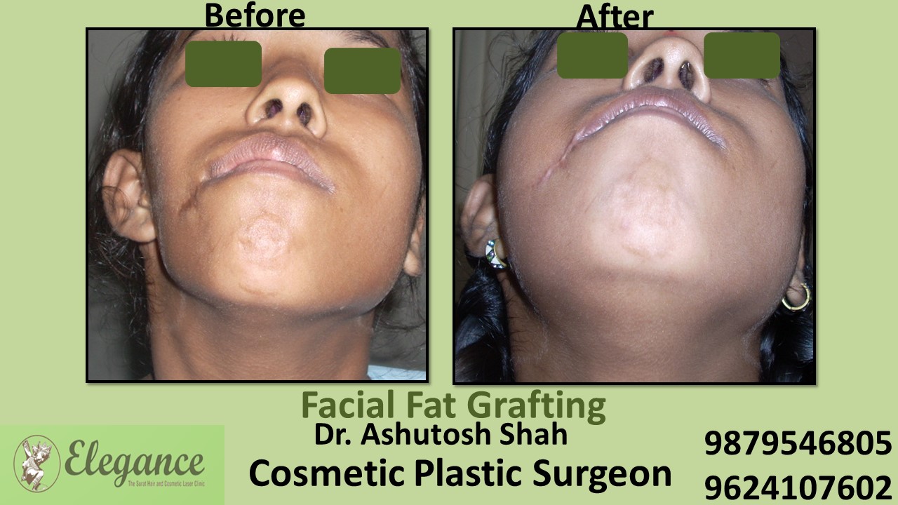 Fat Grafting Surgery Vadodara, Gujarat, India.