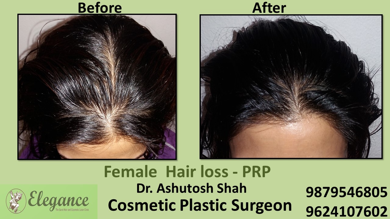 Female Hair Loss Treatment Bharuch, Gujarat, India.