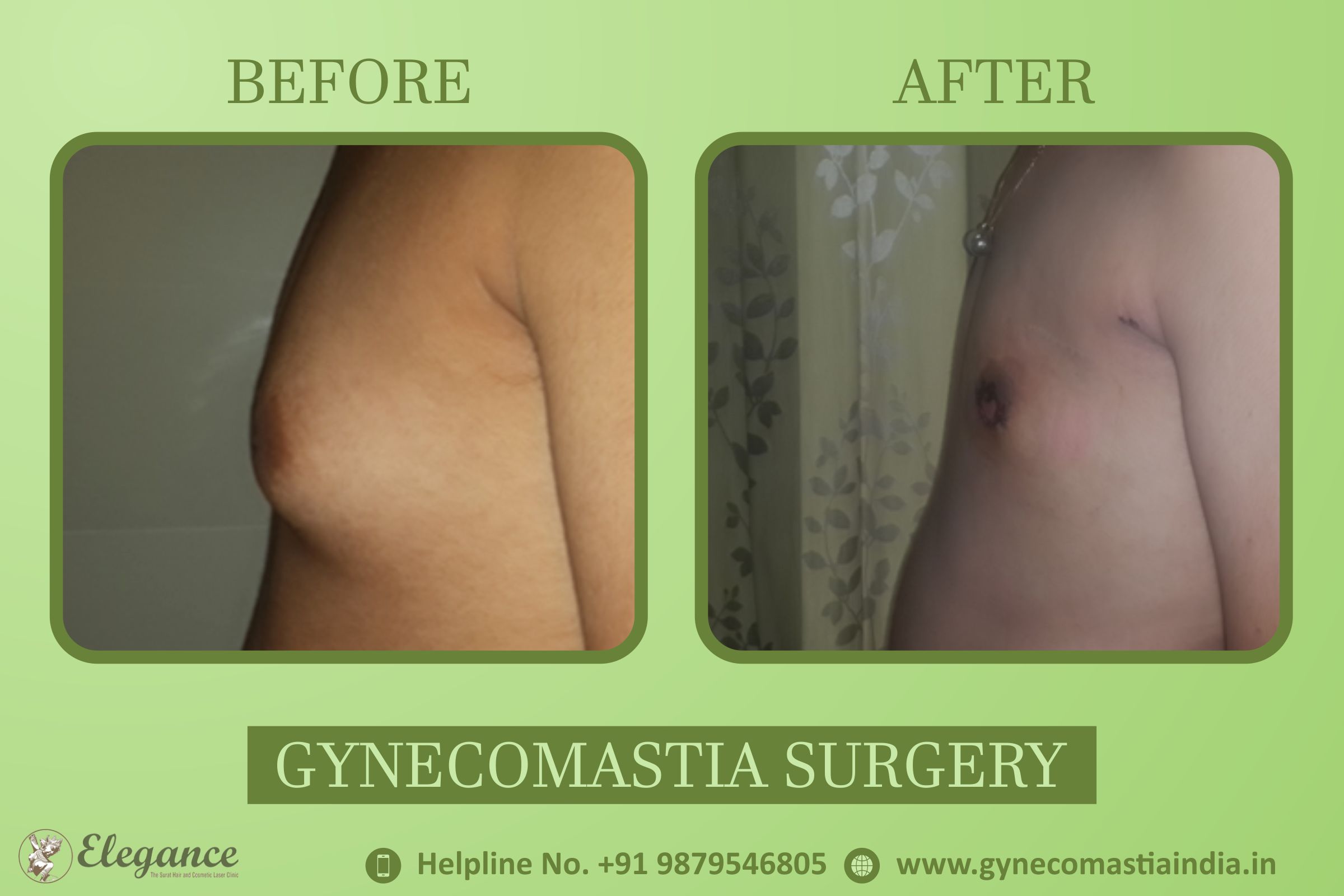 Gynecomastia Before and After Surat, Gujarat, india