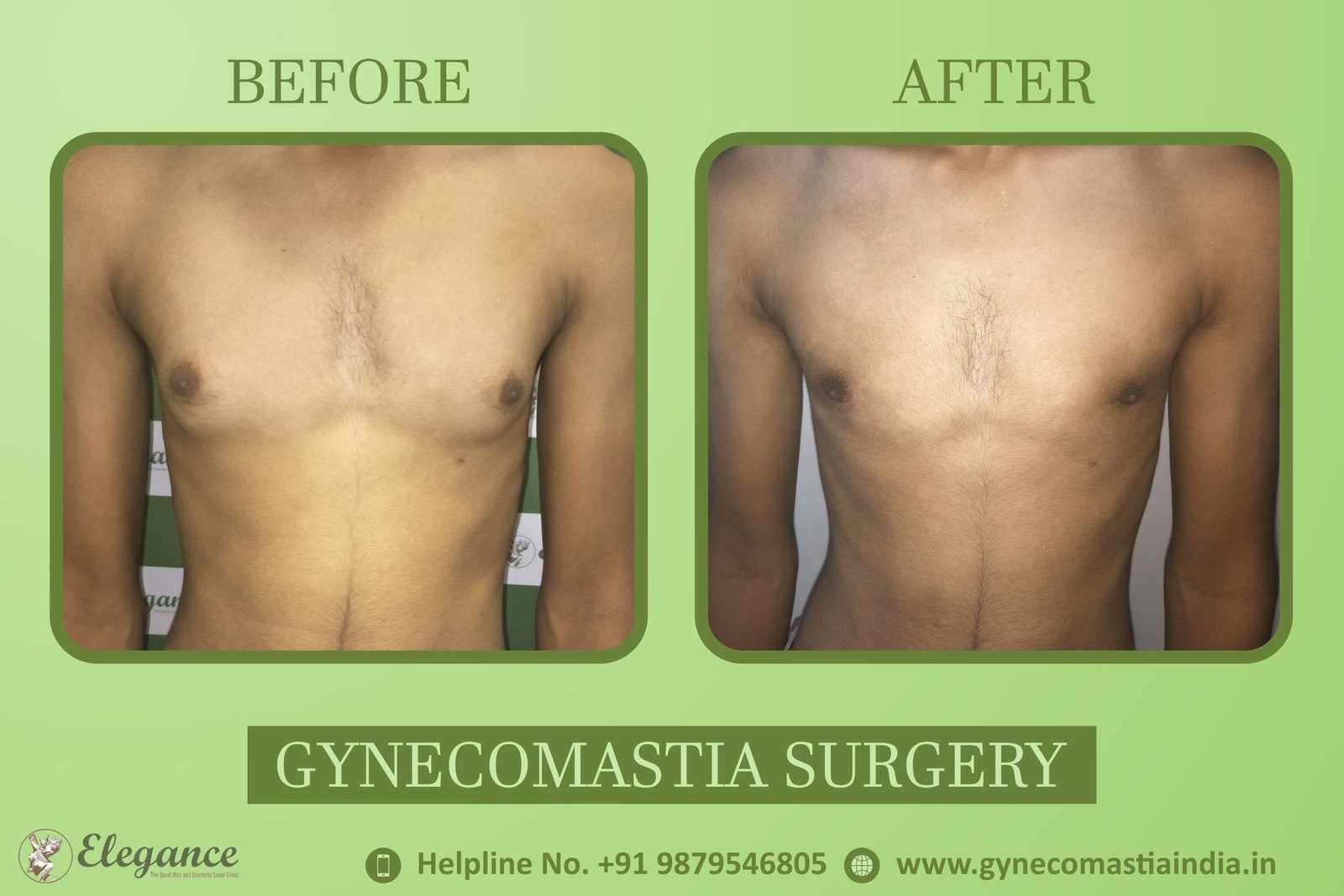 Gynecomastia Cost Surat, Gujarat, india