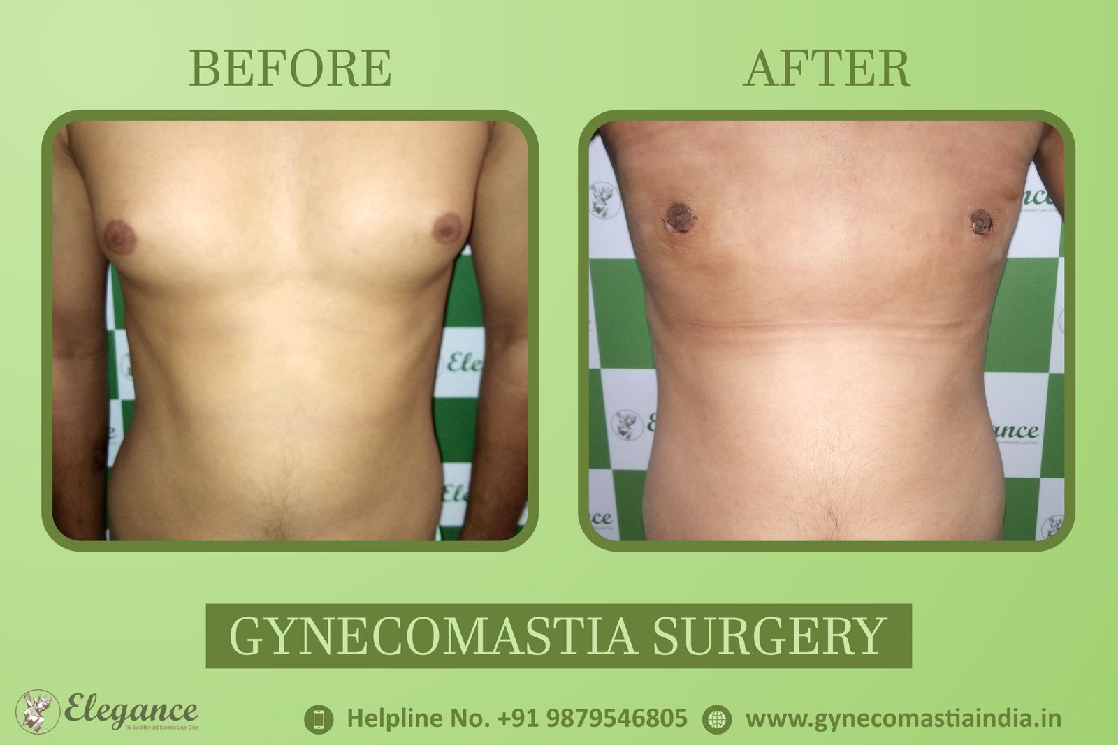 Gynecomastia Cost Valsad, Gujarat, india