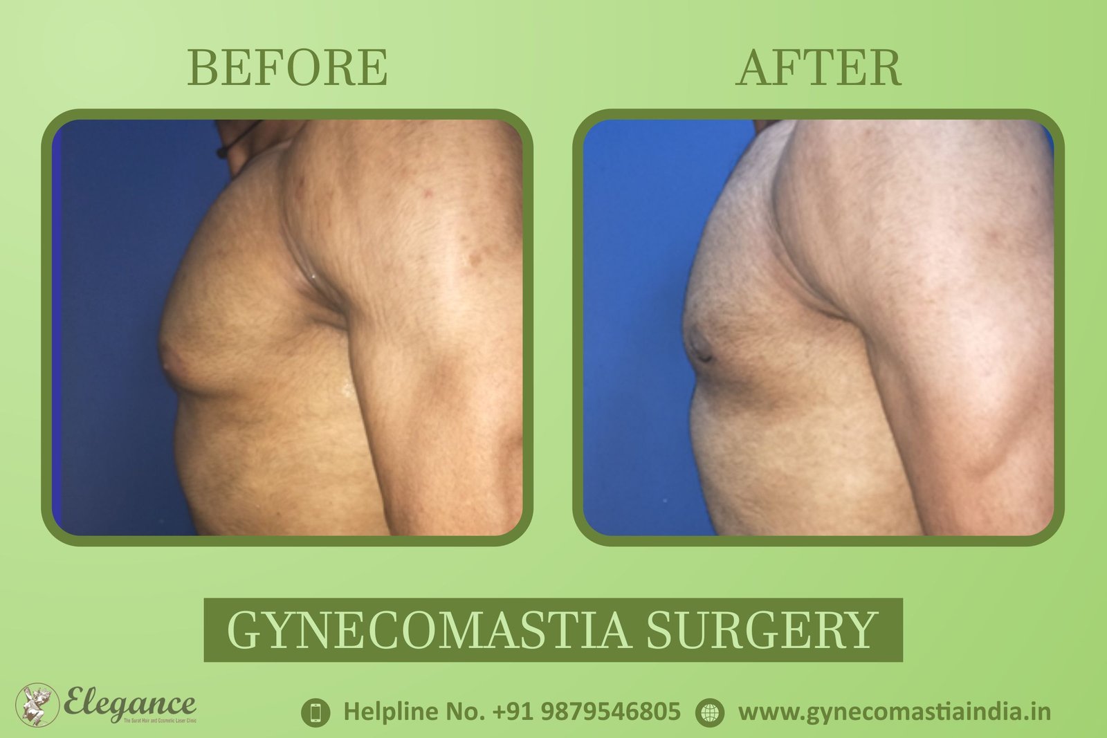 Gynecomastia Procedure Surat, Guajart, india