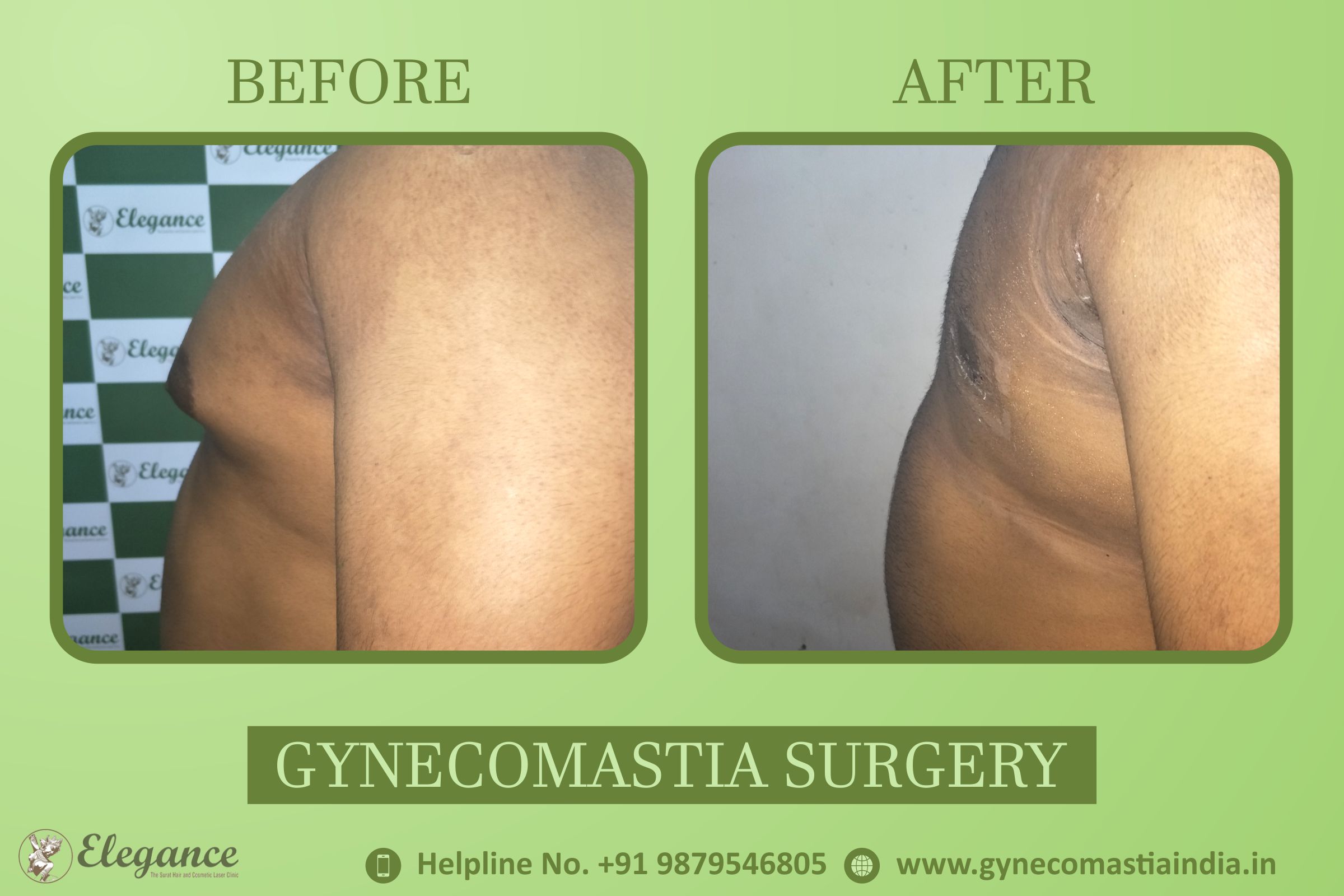 Gynecomastia procedure Vapi, Gujarat, india