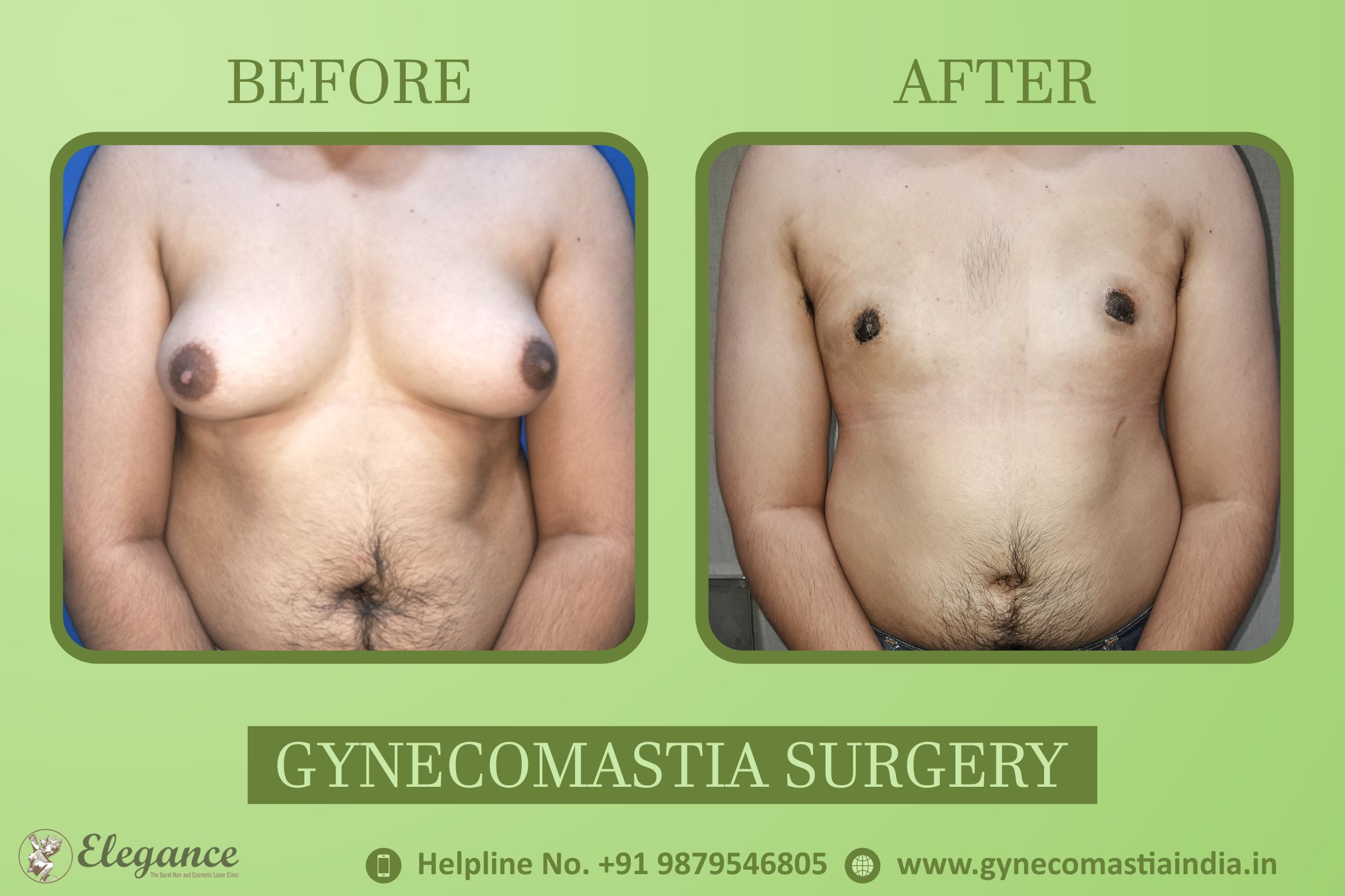 Gynecomastia Results Bardoli, Gujarat, india