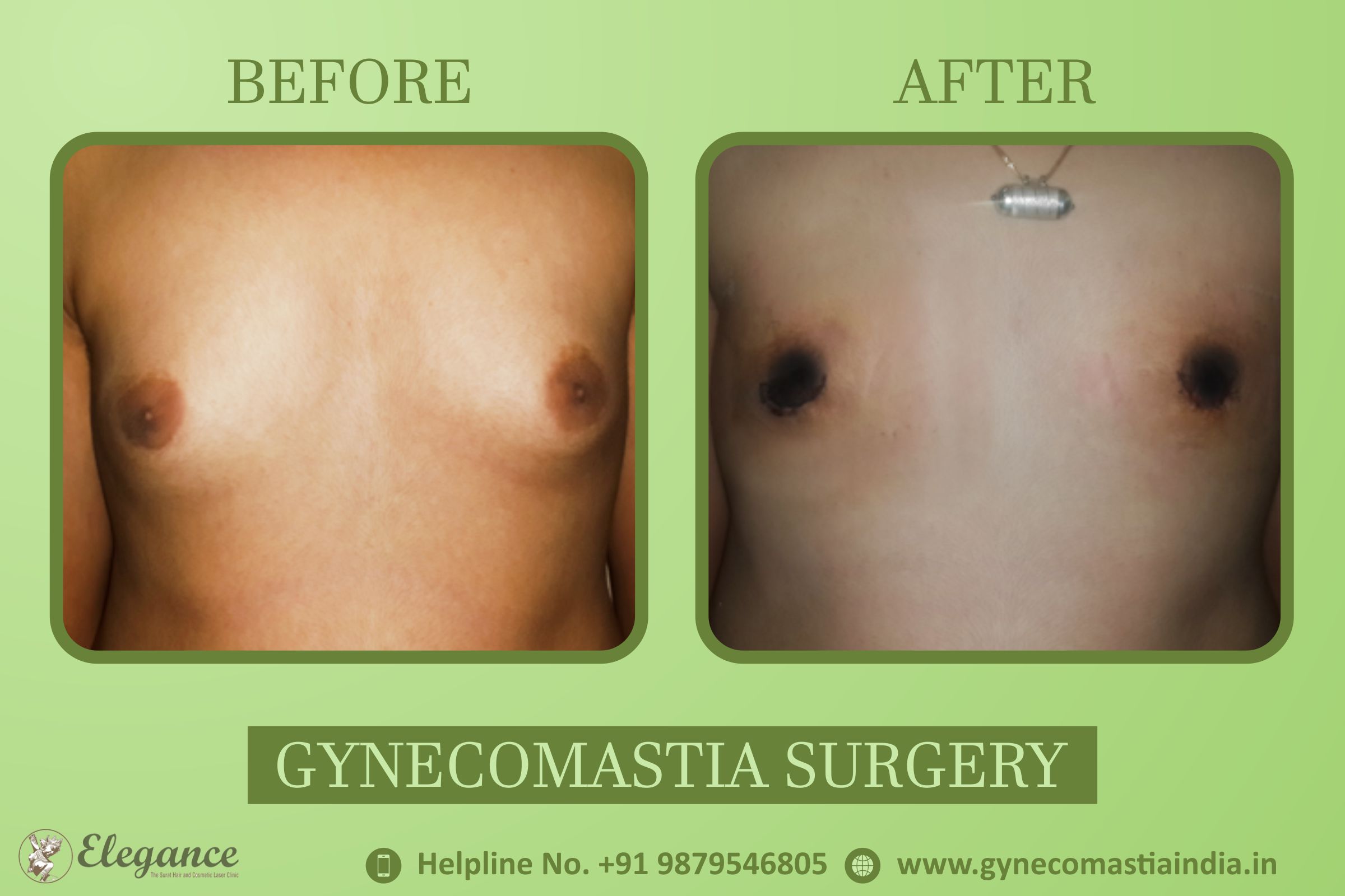 Gynecomastia Results Surat, Gujarat, india