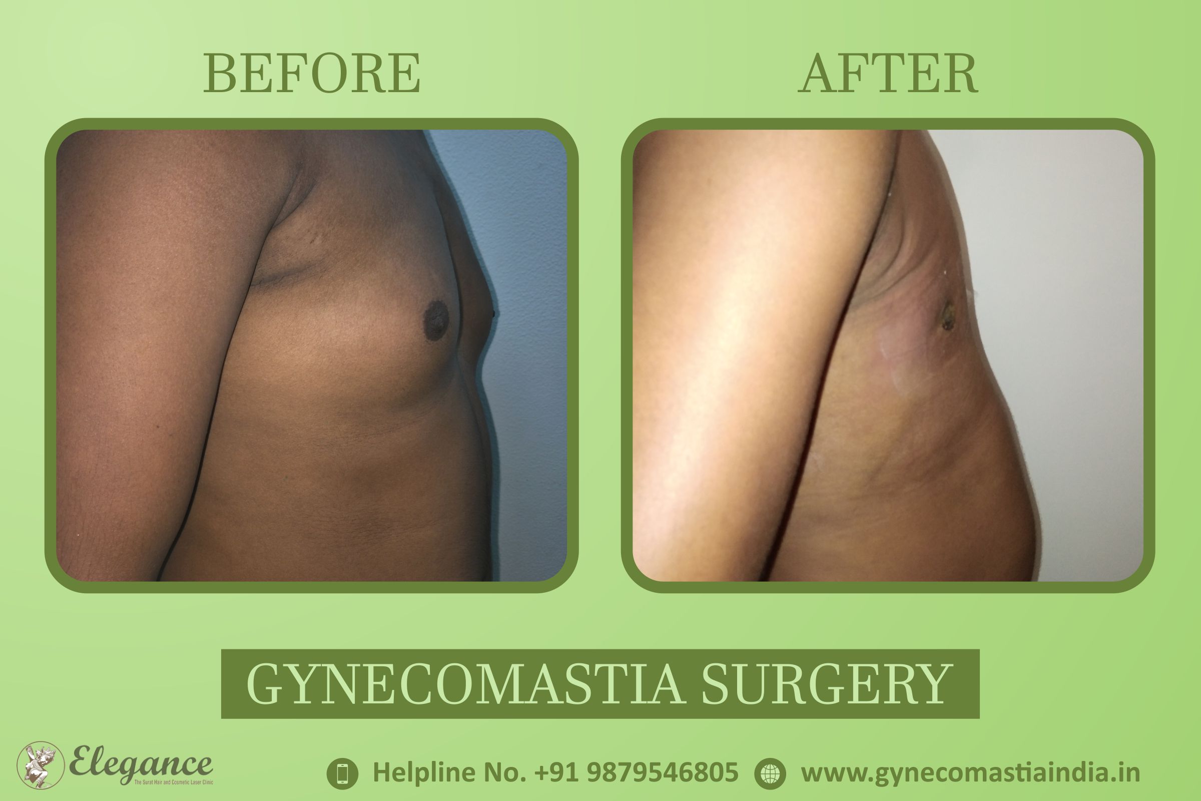 Gynecomastia Results Valsad, Gujarat, india
