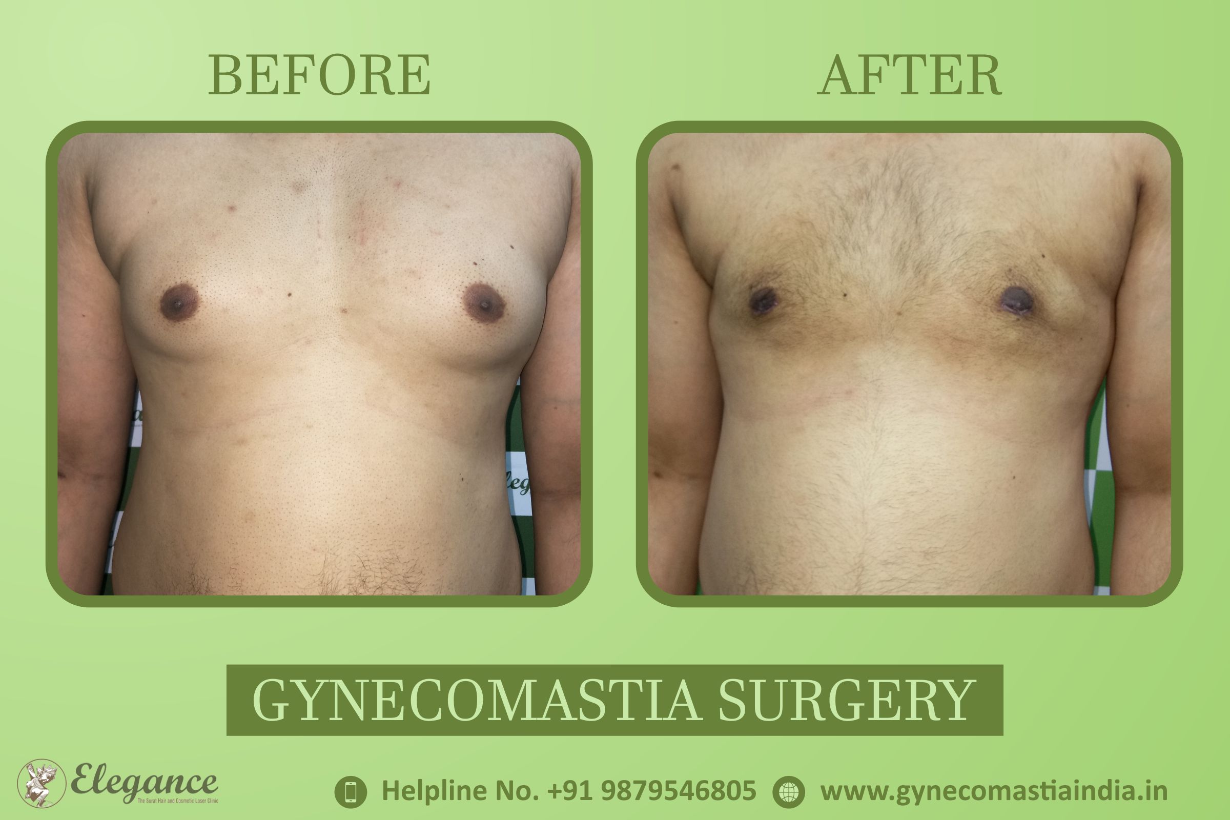 Gynecomastia Results Vapi, Gujarat, india