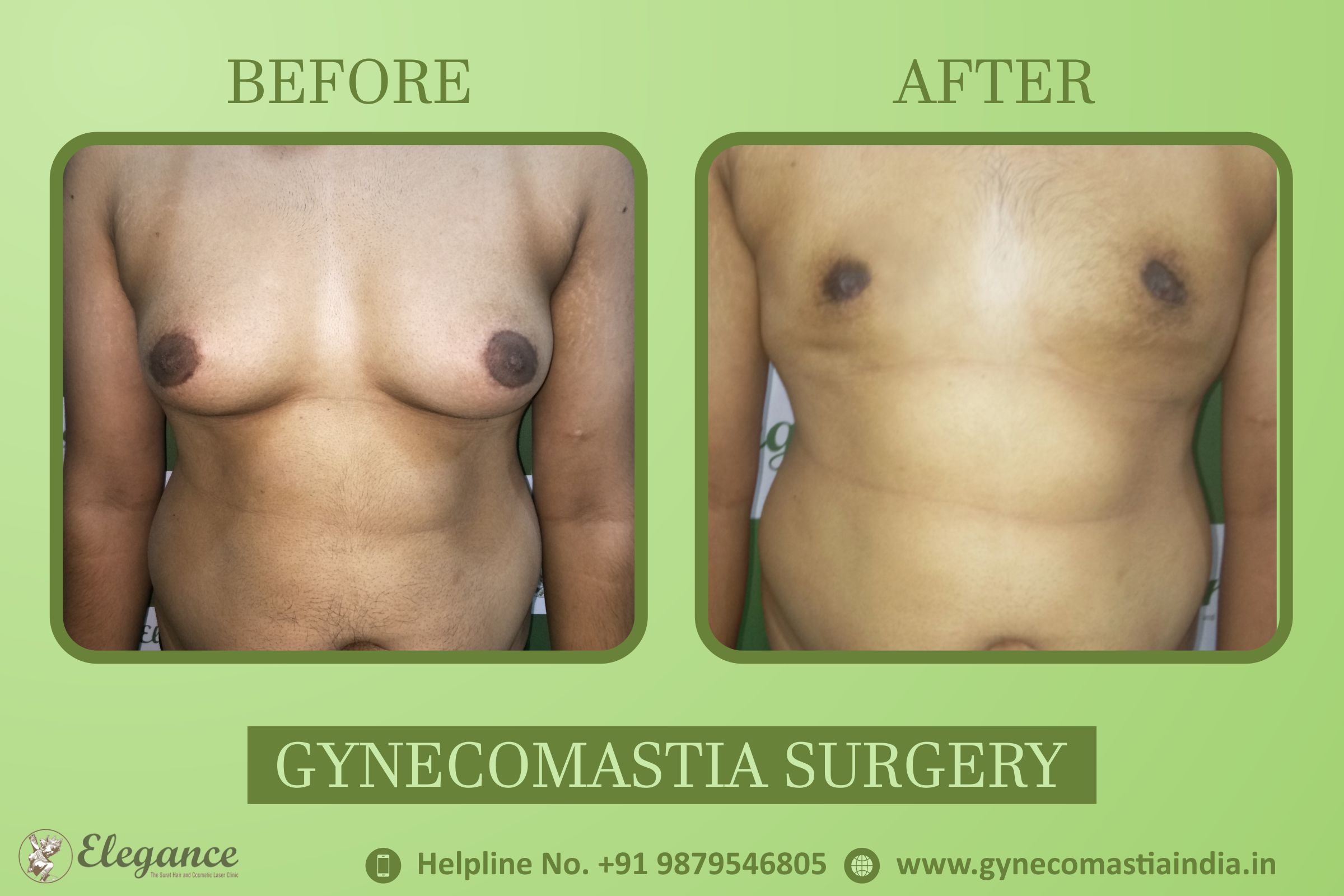 Gynecomastiya Before And After Vapi, Gujarat, india