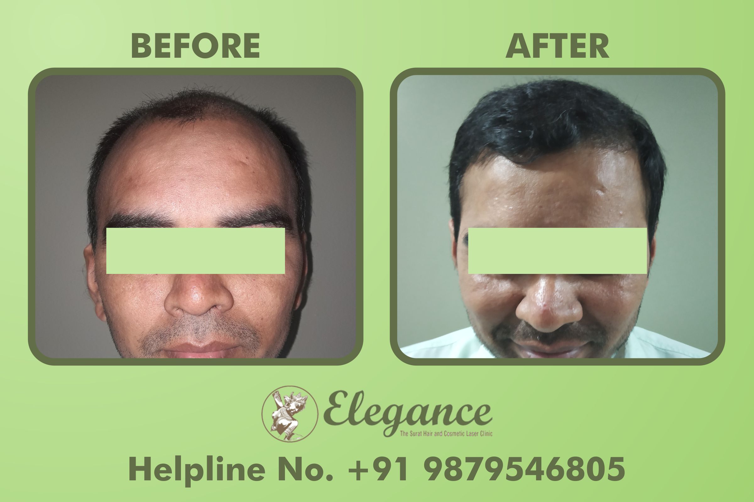 Fue Hair Transplant Results Bharuch, Gujarat, India