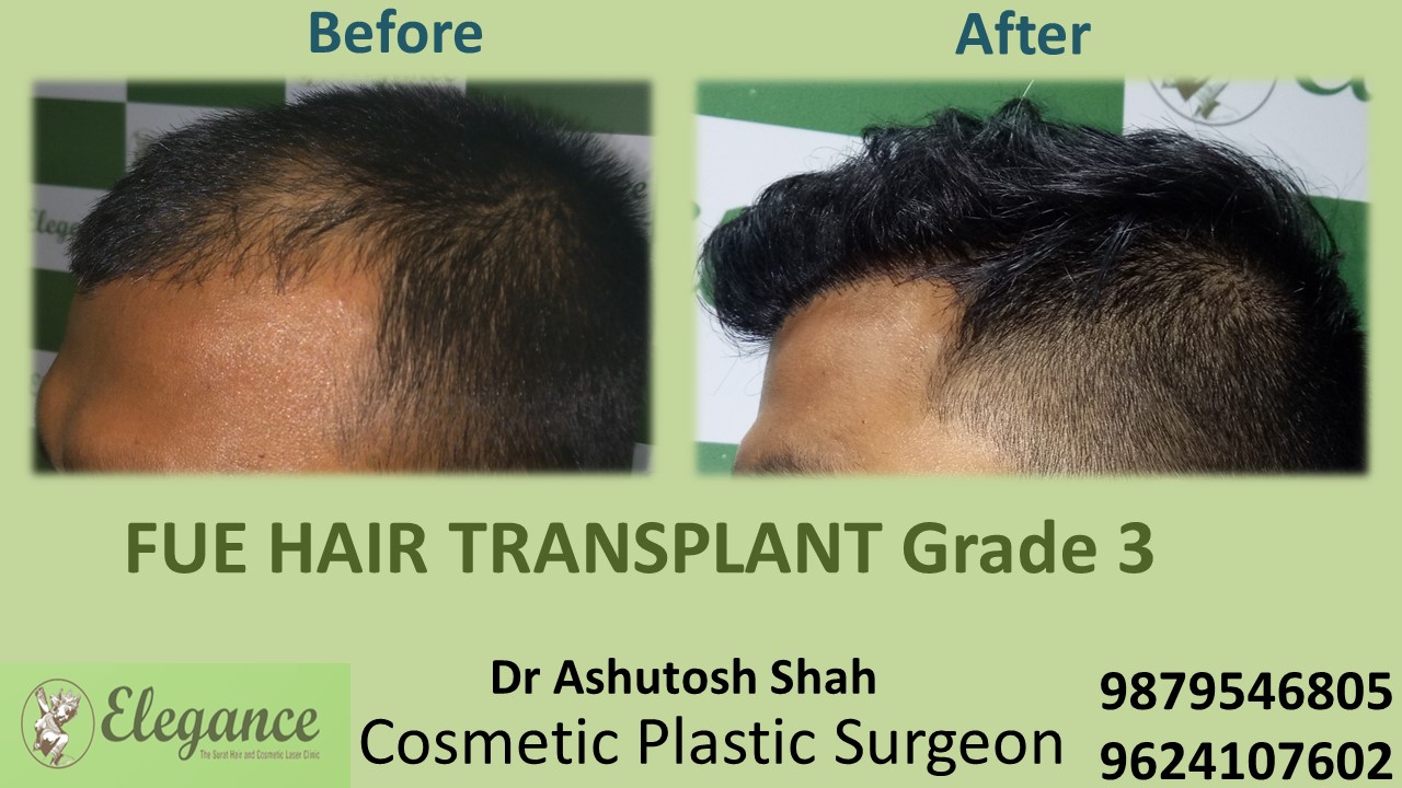 Grade 3 Hair Transplant, Ahemdabad, Gujarat, India.