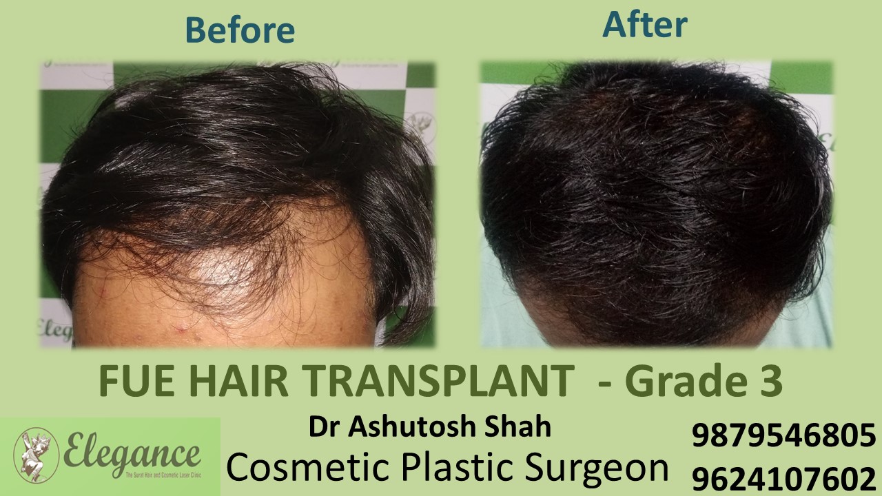 Grade 3 Hair Transplant, Ankleshwar, Gujarat, India.