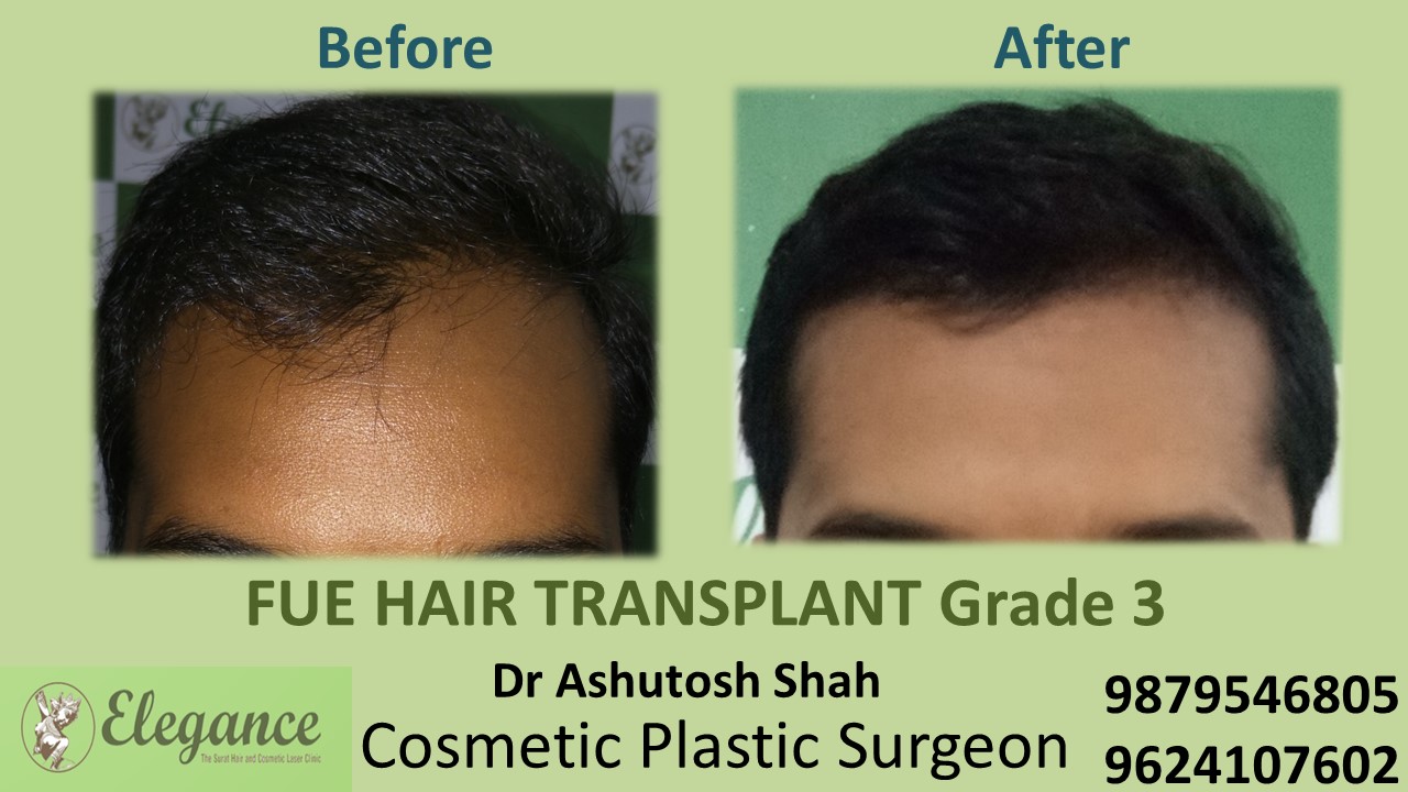Grade 3 Hair Transplant, Bardoli, Gujarat, India.