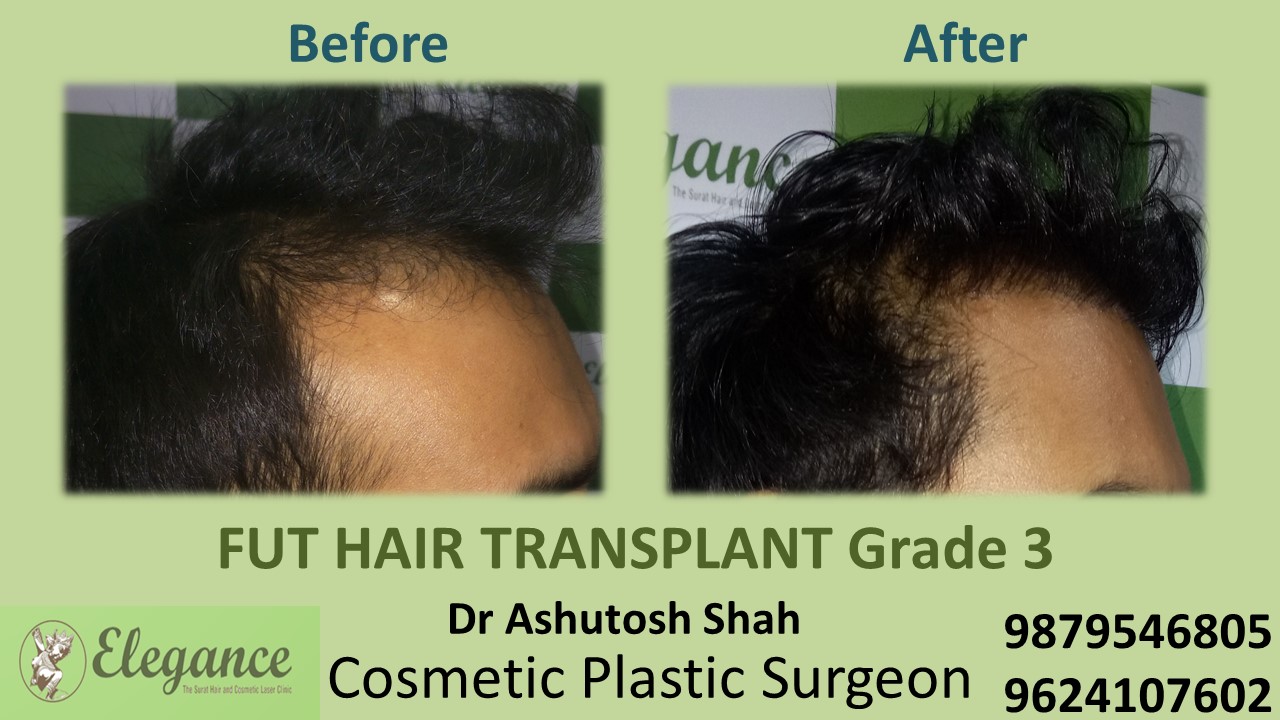 Grade 3 Hair Transplant, Bharuch, Gujarat, India.