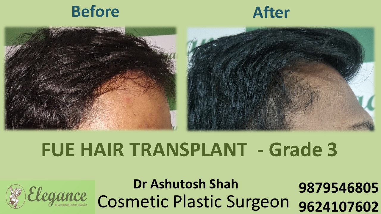 Grade 3 Hair Transplant, Bilimora, Gujarat, India.