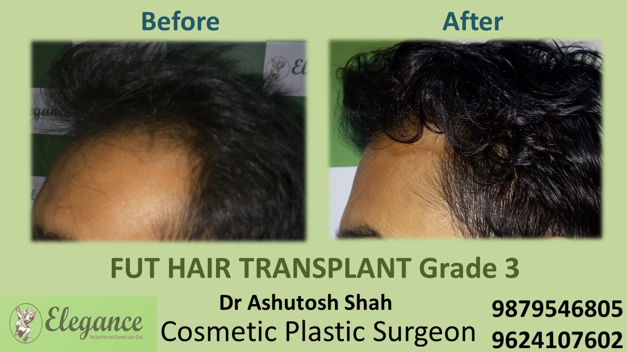 Grade 3 Hair Transplant, Chhota Udaipur, Gujarat, India.