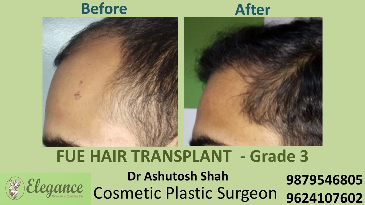 Grade 3 Hair Transplant in Chikhli, Gujarat, India.