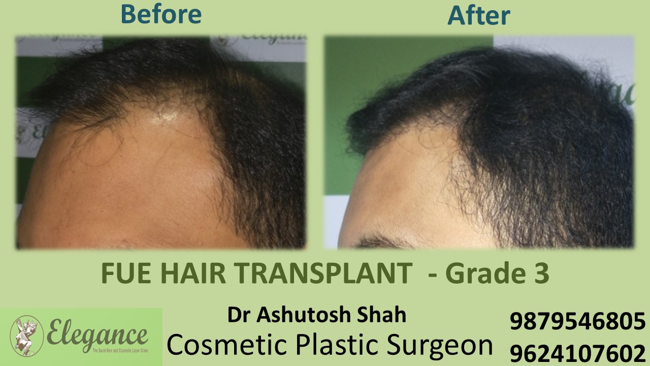 Grade 3 Hair Transplant in Kim, Gujarat, India.