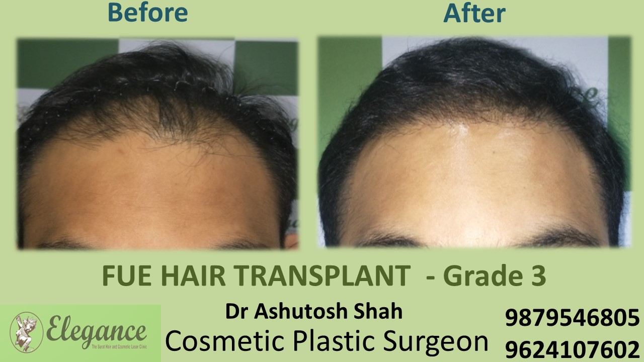 Grade 3 Hair Transplant in Kosamba, Gujarat, India.