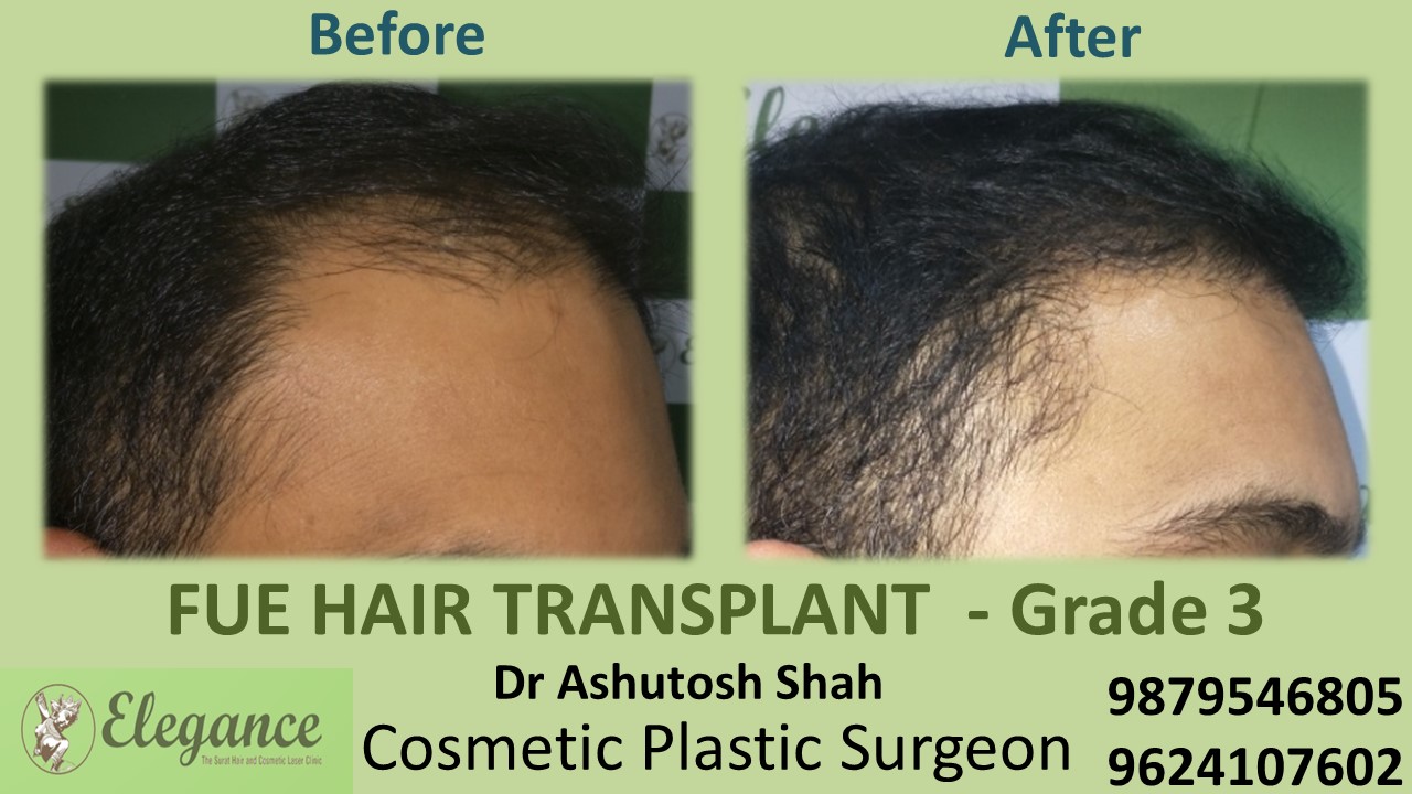 Grade 3 Hair Transplant in Mangrol, Gujarat, India.