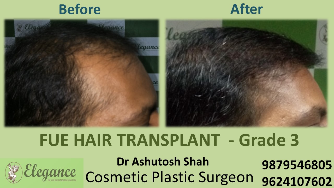 Grade 3 Hair Transplant in Surat, Gujarat, India.