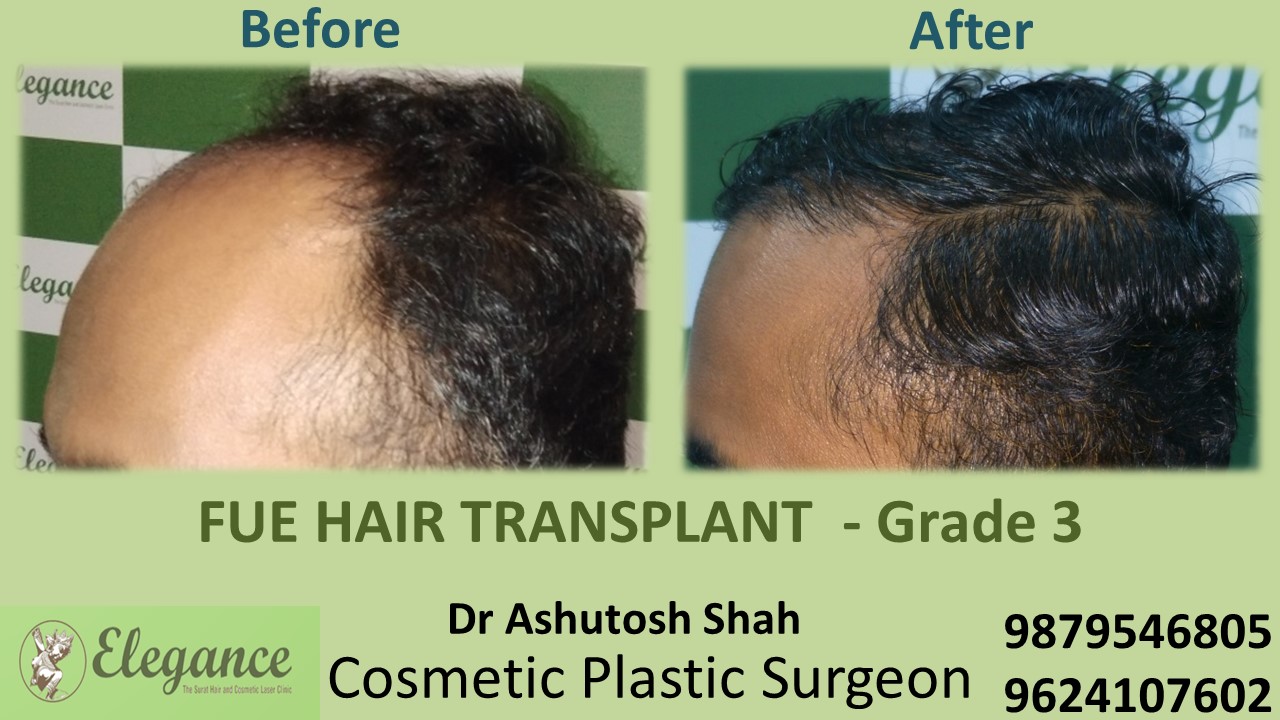 Grade 3 Hair Transplant in Valsad, Gujarat, India.