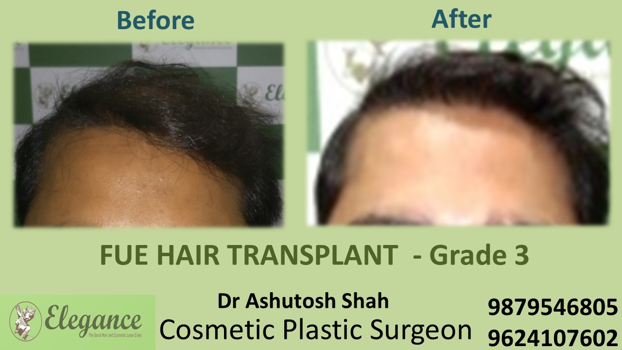 Grade 3 Hair Transplant in Vapi, Gujarat, India.