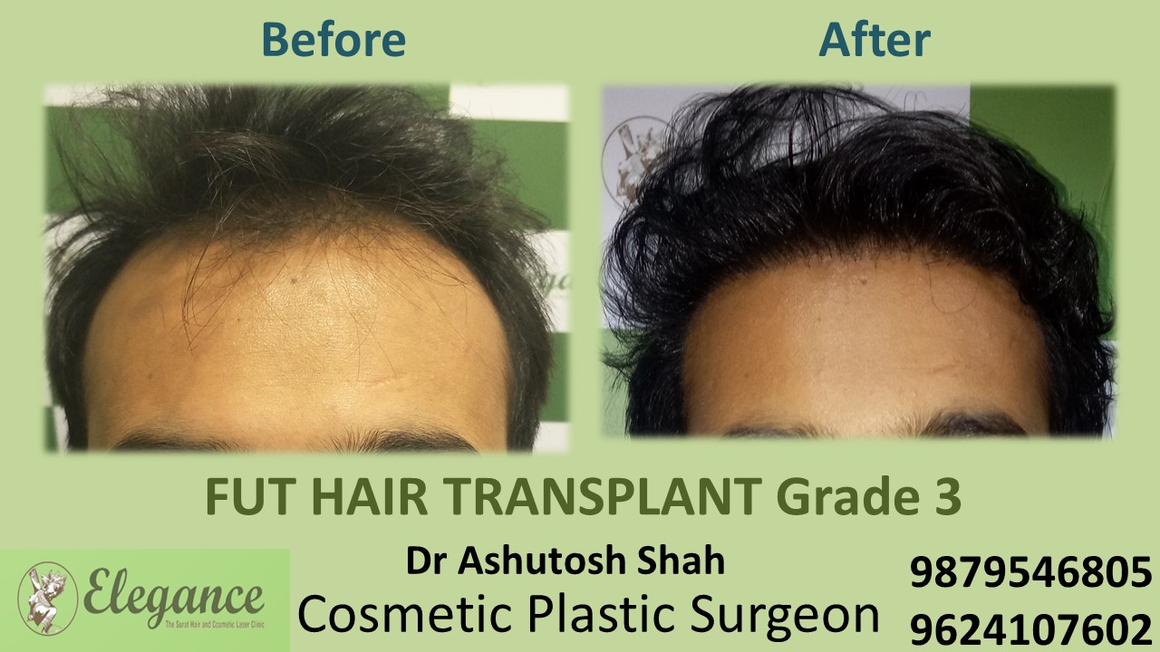Grade 3 Hair Transplant, Kim, Gujarat, India.
