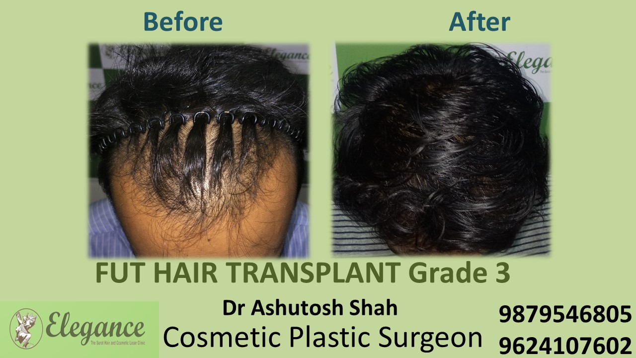 Grade 3 Hair Transplant, Kosamba, Gujarat, India.