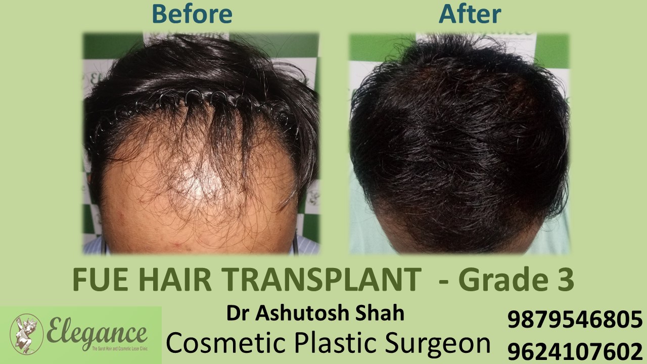 Grade 3 Hair Transplant, Mangrol, Gujarat, India.