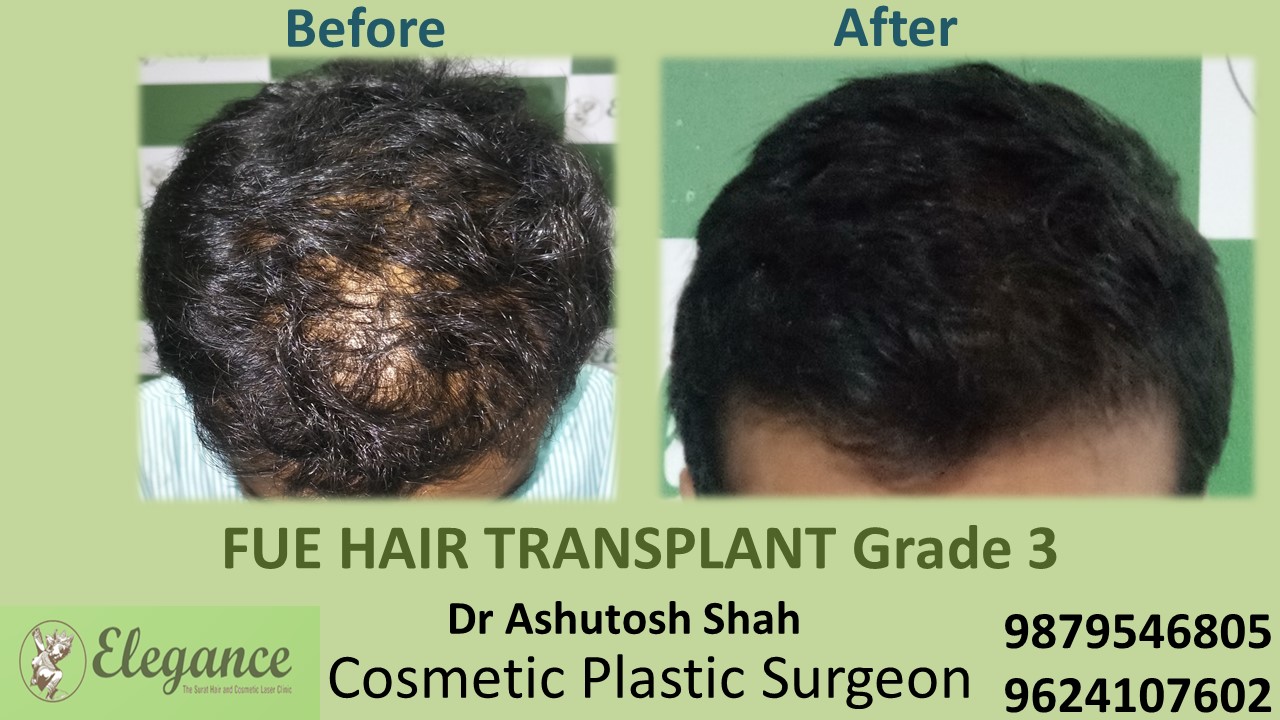 Grade 3 Hair Transplant, Navsari, Gujarat, India.