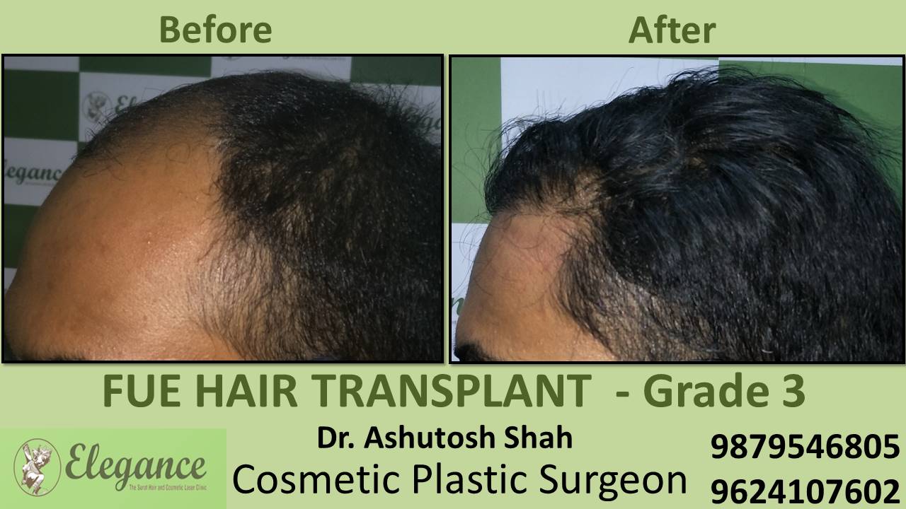 Grade 3 Hair Transplant, Surat, Gujarat, India.