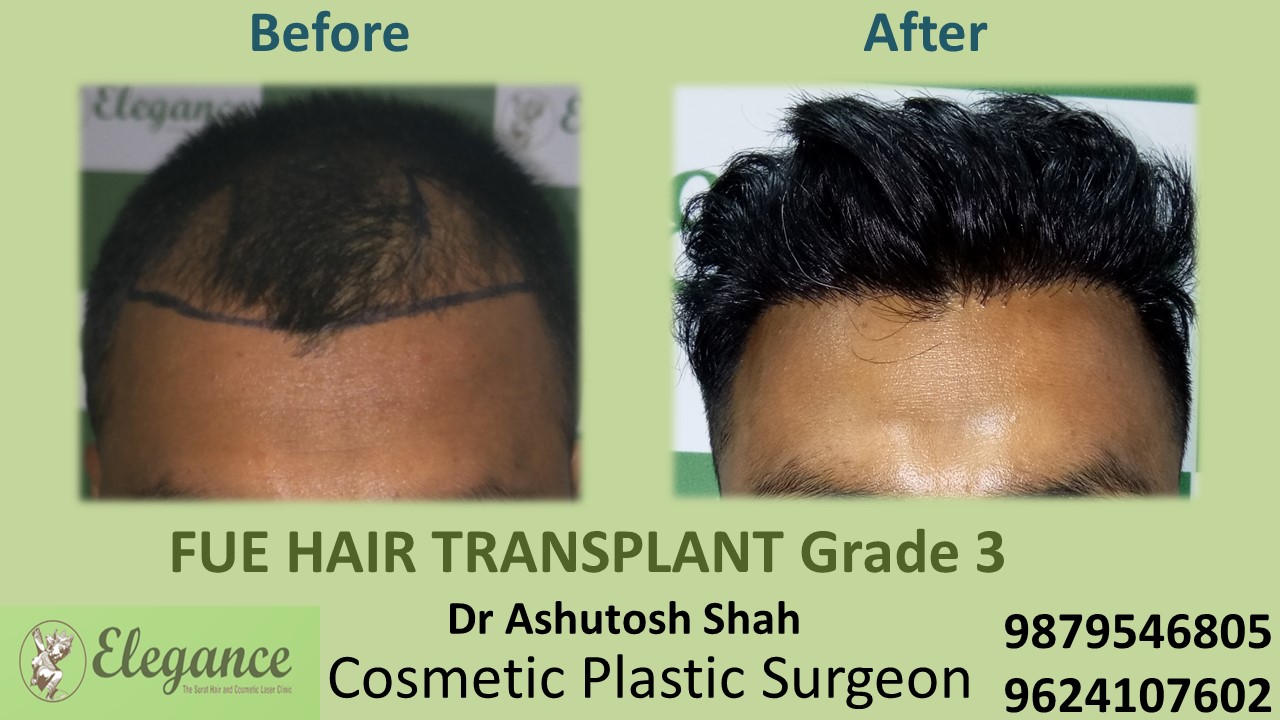 Grade 3 Hair Transplant, Vadodara, Gujarat, India.