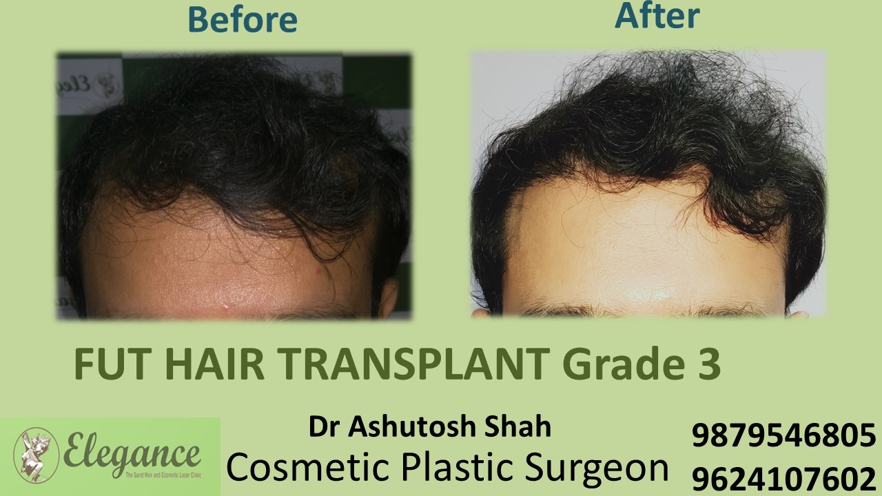 Grade 3 Hair Transplant, Valsad, Gujarat, India.