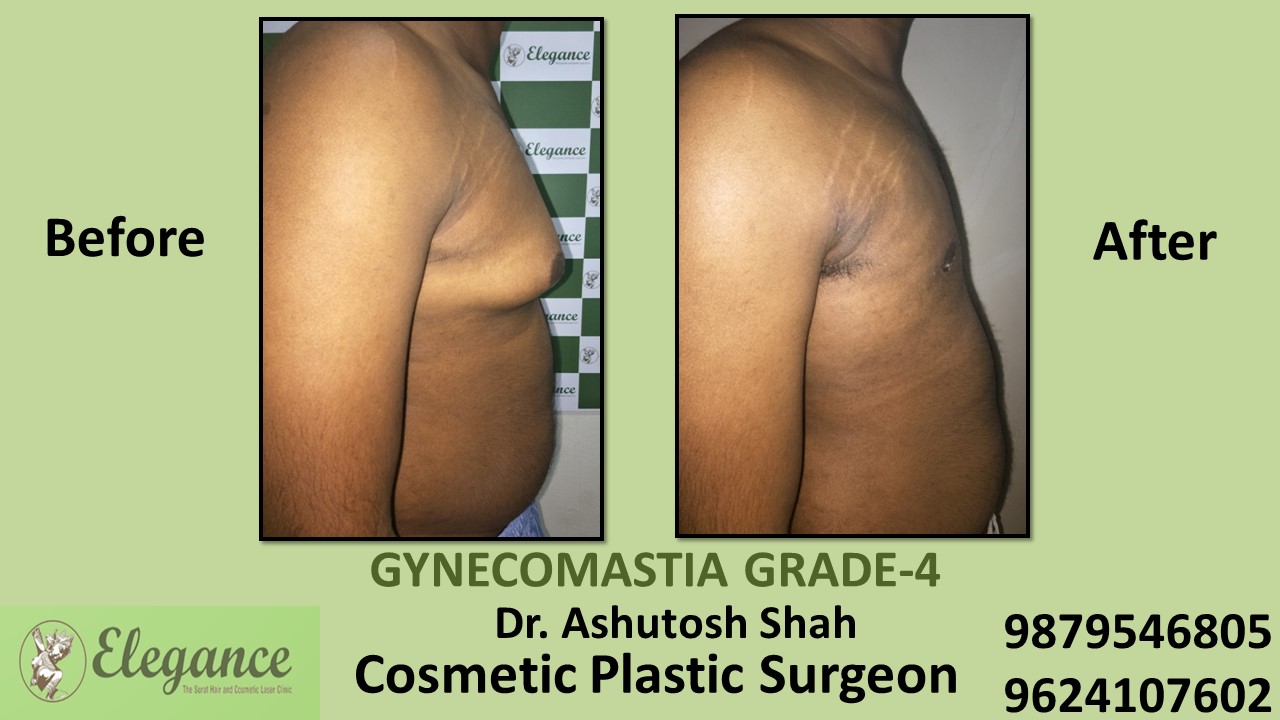 Grade-4 Gynecomastia Treatment in Athwagate, Gujarat, India.