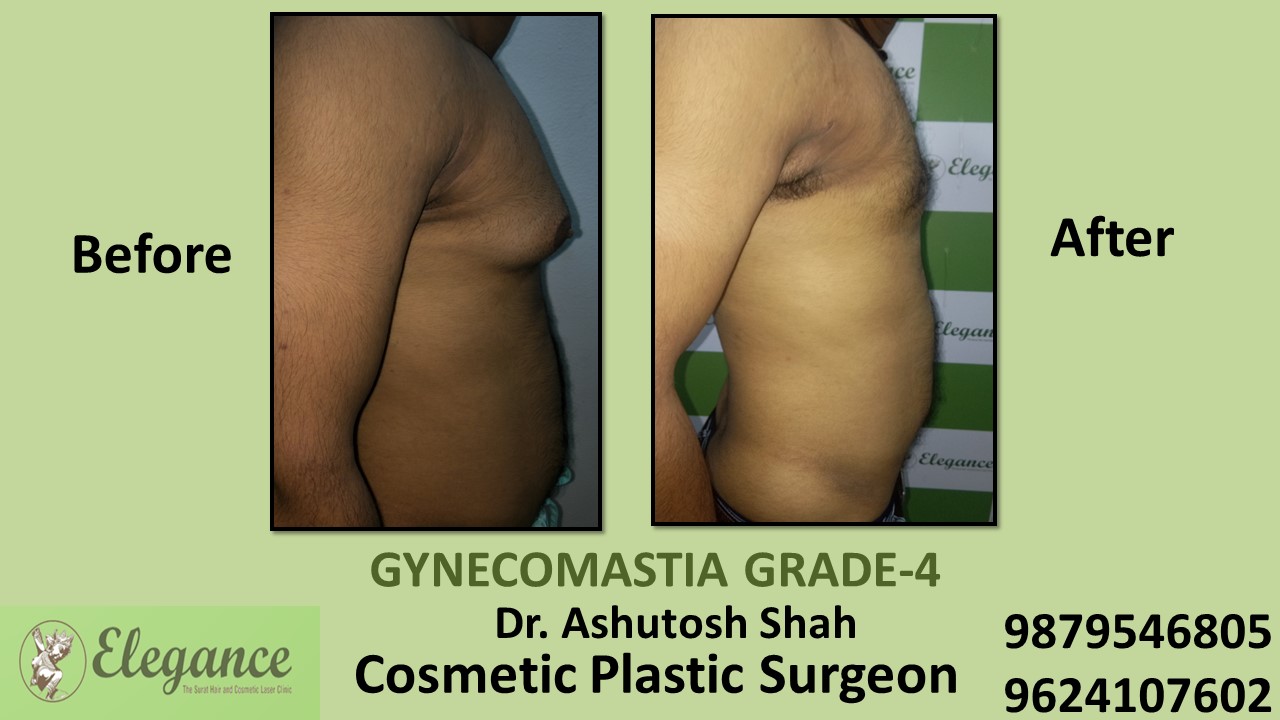 Grade-4 Gynecomastia Treatment in Bilimora, Gujarat, India.
