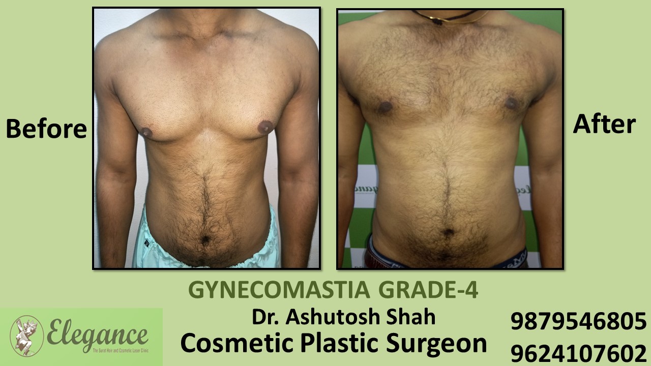 Grade-4 Gynecomastia Treatment in Chikhli, Gujarat, India.