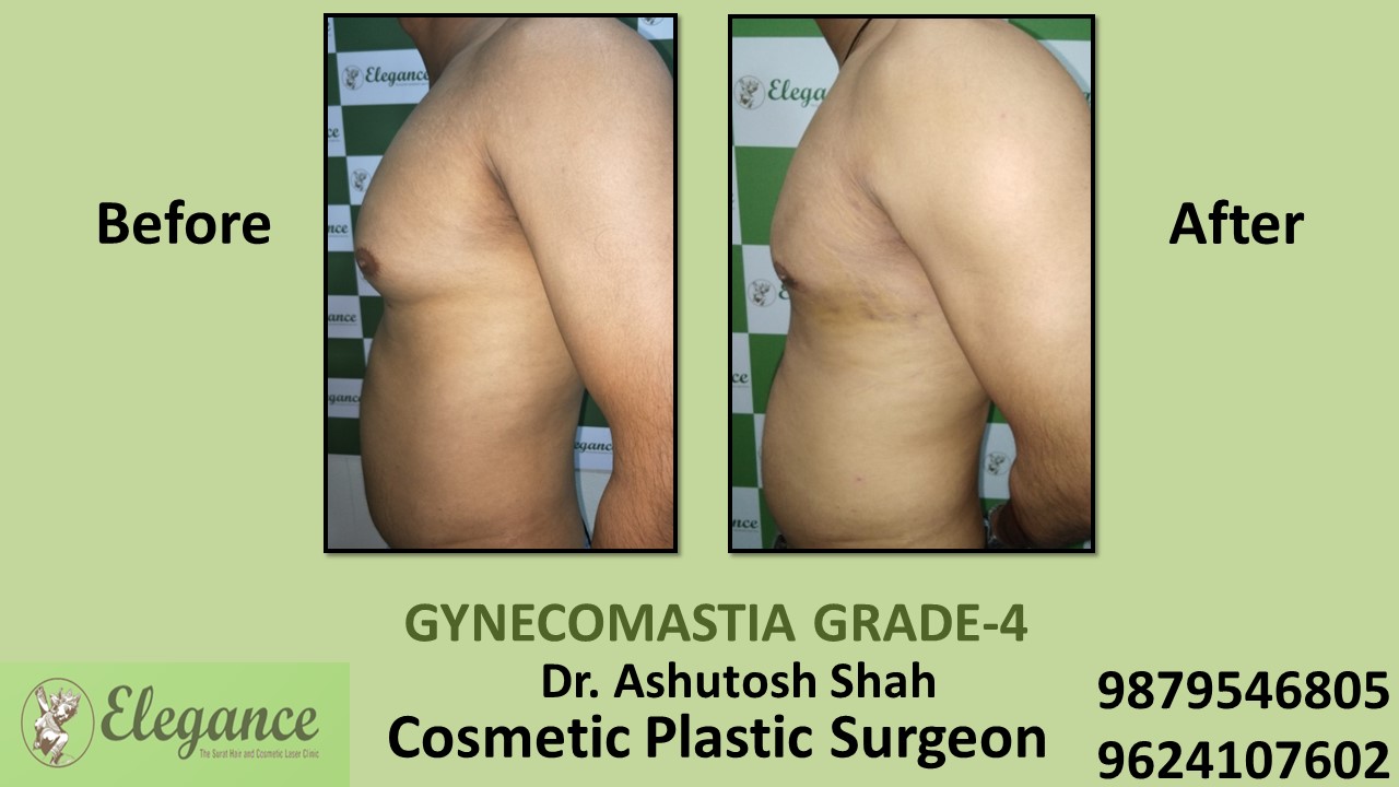 Grade-4 Gynecomastia Treatment in Citylight, Gujarat, India.