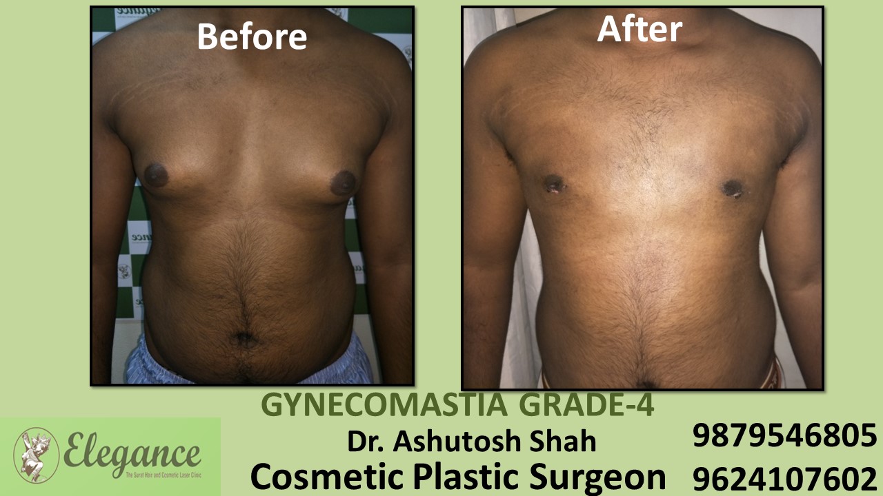 Grade-4 Gynecomastia Treatment in Hazira, Gujarat, India.