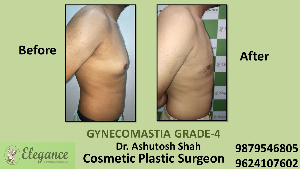 Grade-4 Gynecomastia Treatment in Kamrej, Gujarat, India.