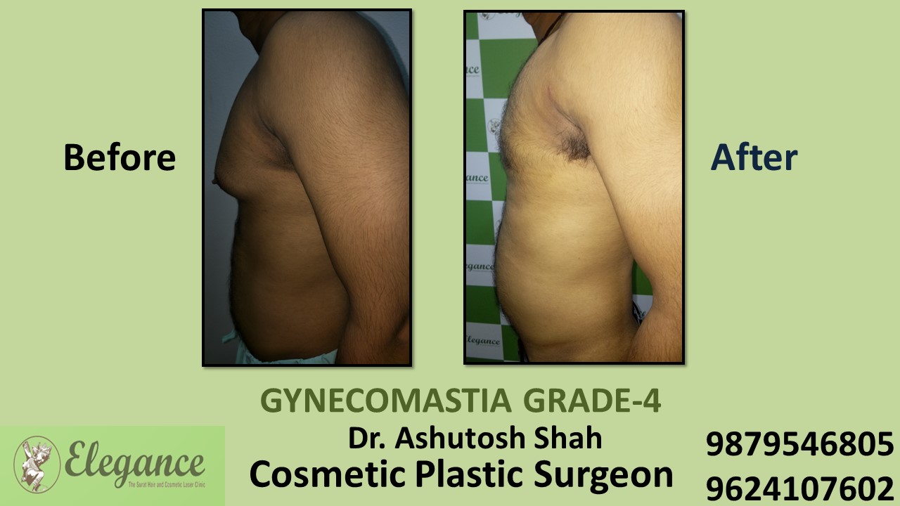 Grade-4 Gynecomastia Treatment in Kim, Gujarat, India.