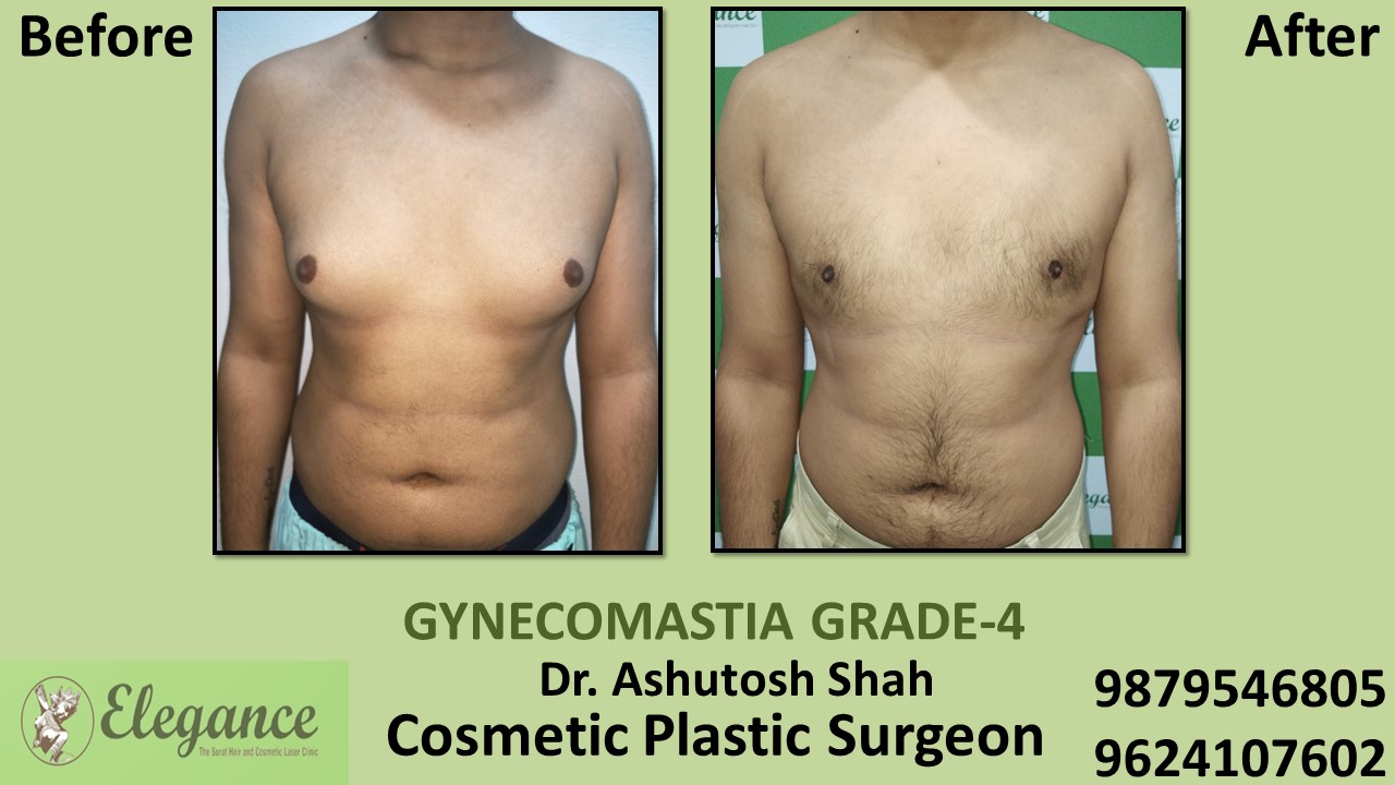 Grade-4 Gynecomastia Treatment in Kosamba, Gujarat, India.