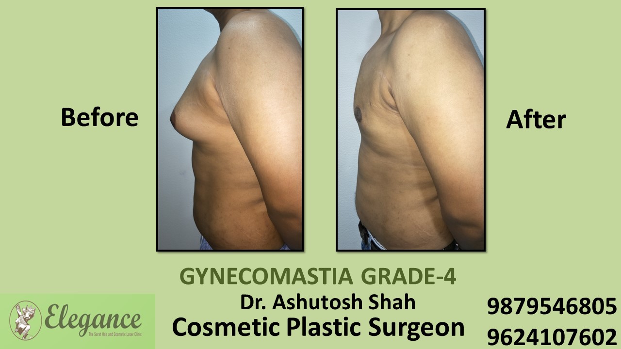 Grade-4 Gynecomastia Treatment in Mangrol, Gujarat, India.