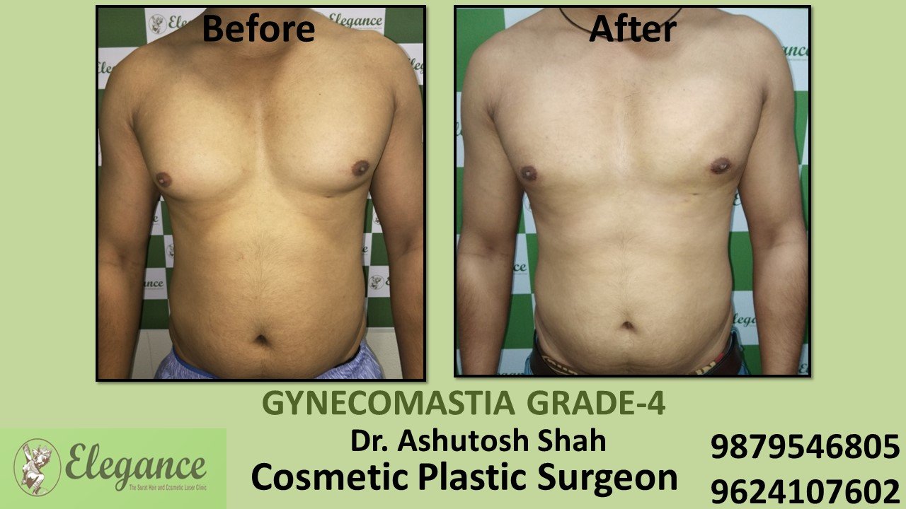 Grade-4 Gynecomastia Treatment in Ring Road, Gujarat, India.