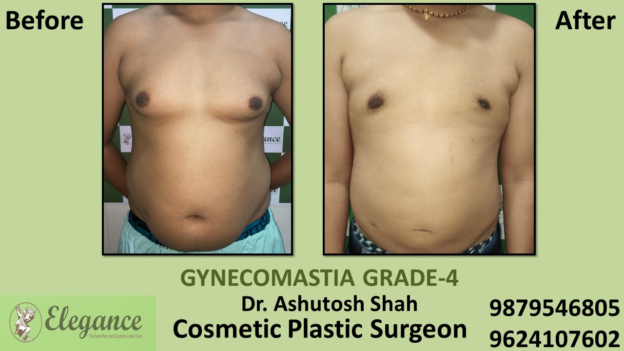 Grade-4 Gynecomastia Treatment in Selvasa, Gujarat, India.