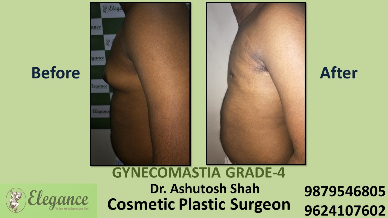 Grade-4 Gynecomastia Treatment in Udhna, Gujarat, India.