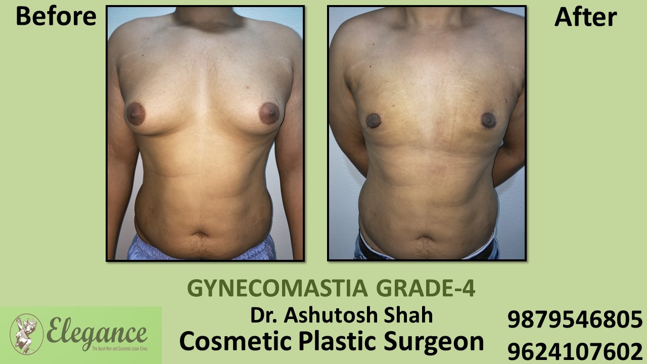 Grade-4 Gynecomastia Treatment in Valsad, Gujarat, India.