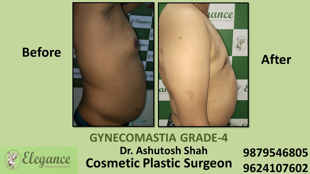 Grade-4 Gynecomastia Treatment in Vapi, Gujarat, India.