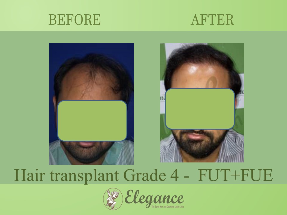 Grade 4 in Hair Transplant, Bardoli, Gujarat, India.
