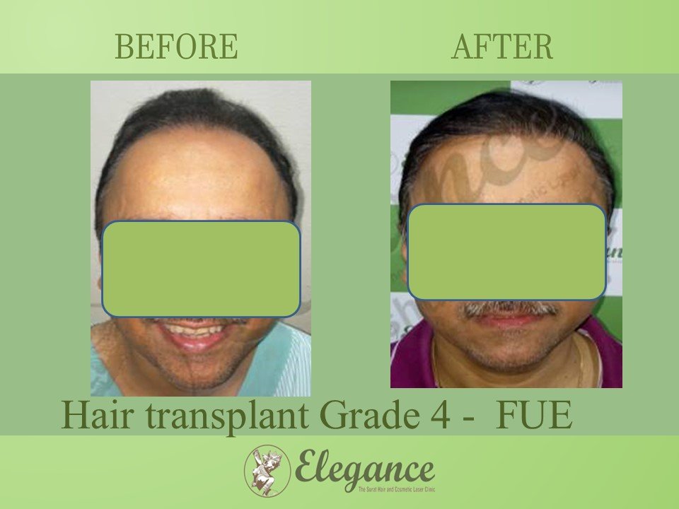 Grade 4 in Hair Transplant, Bharuch, Gujarat, India.