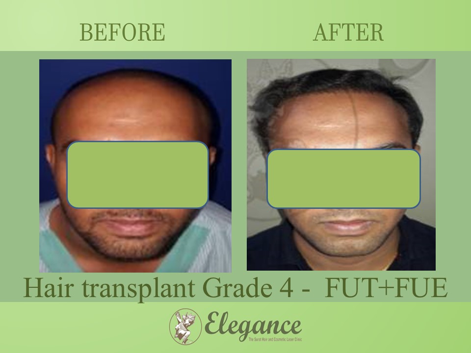 Grade 4 in Hair Transplant, Mangrol, Gujarat, India.